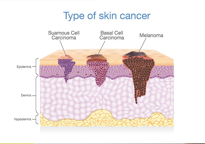 Types-Of-Skin-Cancer_BLOGSIZED